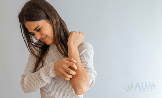 Eczema