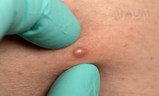 Folliculitis