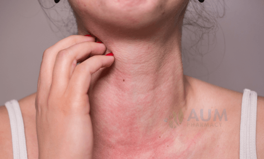 Food allergies
