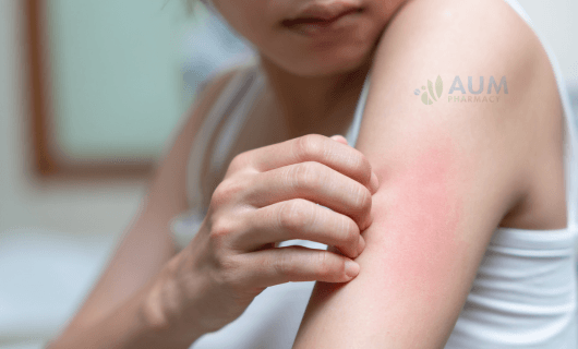 Heat rash