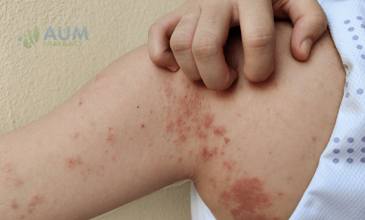 Impetigo