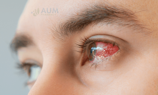 Keratitis