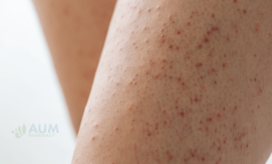 Keratosis pilaris