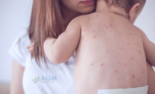 Measles