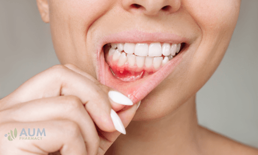Mouth ulcers