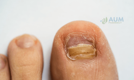 Nail infections