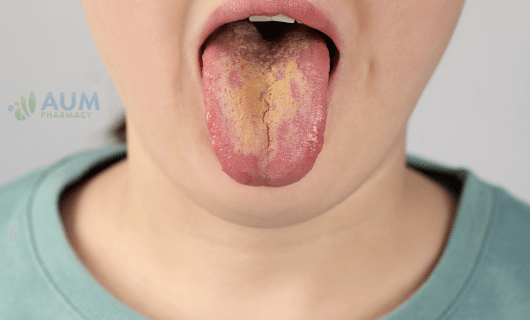 Oral thrush