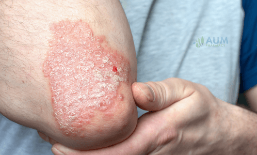 Psoriasis