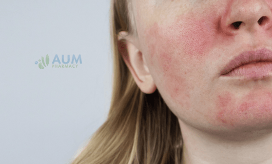 Rosacea