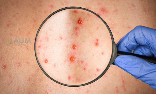 Rubella