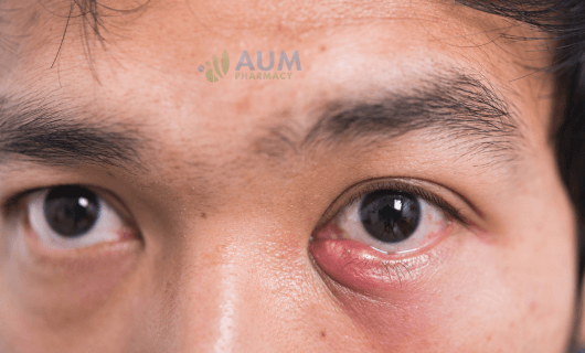 Stye
