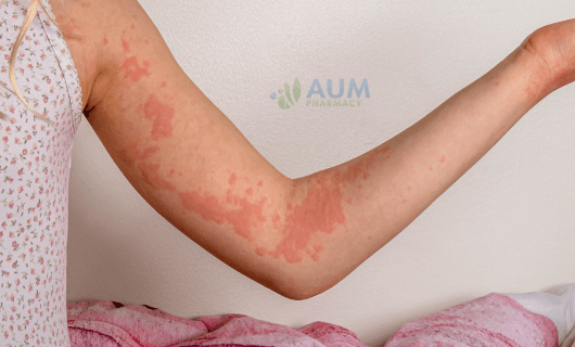 Urticaria
